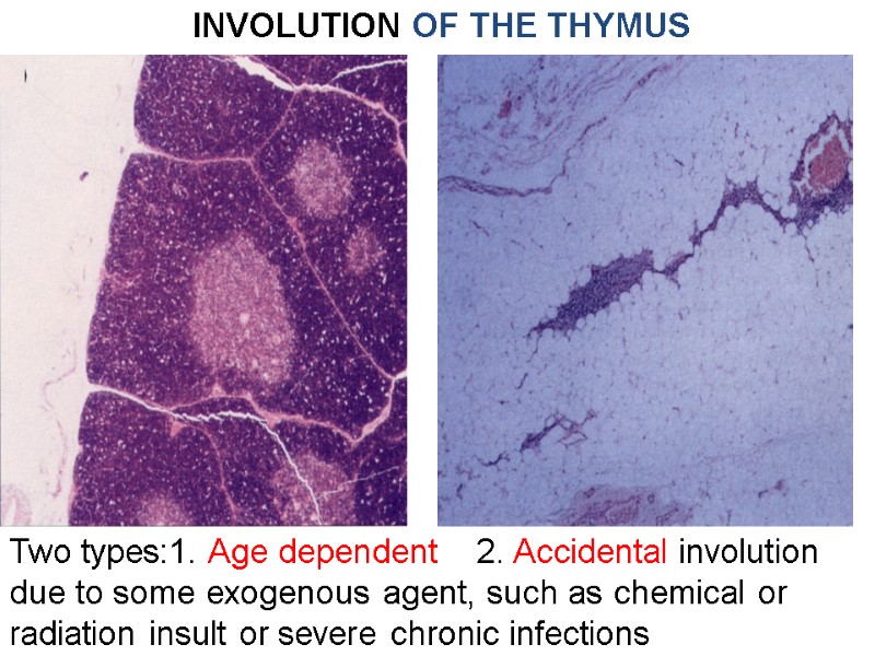 INVOLUTION OF THE THYMUS Two types:1. Age dependent    2. Accidental involution